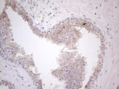 Immunohistochemistry: HGF Antibody (1D2) [NBP2-45972] - Analysis of Carcinoma of Human prostate tissue. (Heat-induced epitope retrieval by 1mM EDTA in 10mM Tris buffer (pH8.5) at 120C for 3 min)