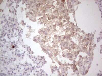 Immunohistochemistry: HGF R/c-MET Antibody (1E6) [NBP2-45822] - Analysis of Human lung carcinoma tissue.