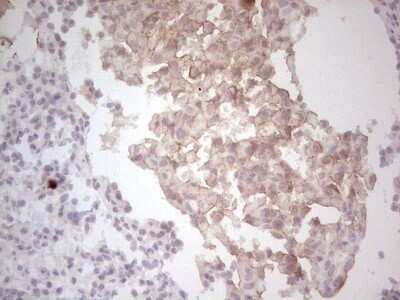 Immunohistochemistry: HGFR/c-MET Antibody (OTI1E6) - Azide and BSA Free [NBP2-71196] - Analysis of Human lung carcinoma tissue.