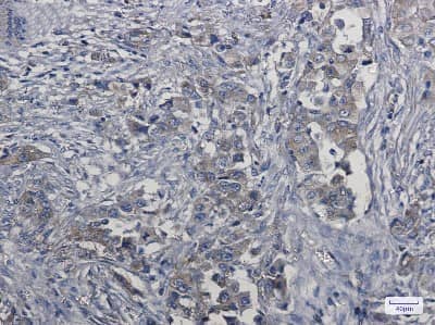 Immunohistochemistry-Paraffin: HGFR/c-MET Antibody (S02-4D6) [NBP3-14873] - Immunohistochemistry of HGFR/c-MET in paraffin-embedded Human lung cancer tissue using HGFR/c-MET Rabbit mAb at dilution 1/5