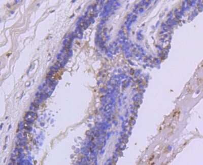 Immunohistochemistry-Paraffin: HGFR/c-MET Antibody (SJ19-05) [NBP2-67412] - Analysis of paraffin-embedded human breast carcinoma tissue using anti-Met antibody. Counter stained with hematoxylin.