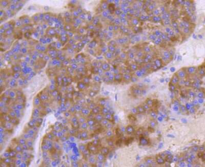 Immunohistochemistry-Paraffin: HGFR/c-MET Antibody (SJ19-05) [NBP2-67412] - Analysis of paraffin-embedded human liver cancer tissue using anti-Met antibody. Counter stained with hematoxylin.