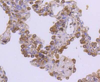 Immunohistochemistry-Paraffin: HGFR/c-MET Antibody (SJ19-05) [NBP2-67412] - Analysis of paraffin-embedded human lung cancer tissue using anti-Met antibody. Counter stained with hematoxylin.