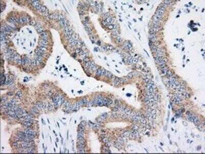 Immunohistochemistry-Paraffin: HIBCH Antibody (3H5) [NBP2-02673] - Staining of paraffin-embedded Adenocarcinoma of Human colon tissue using anti-HIBCH mouse monoclonal antibody.