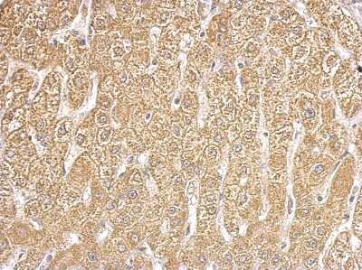 Immunohistochemistry-Paraffin: HIBCH Antibody [NBP1-32964] - Paraffin-embedded hepatoma tissue; antibody dilution 1:500.
