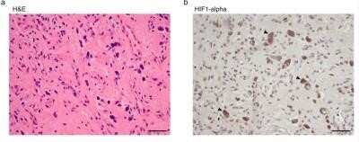 Immunocytochemistry: HIF-1 alpha Antibody (ESEE122) - Azide and BSA Free [NBP2-80762] - Histologically distinct cell types in hemangioblastomas do not arise from a common ancestral clone. Representative images of sample SH-0622 acquired at 400x of (a) H + E and IHC for (b) HIF1-alpha reveal heterogenous cell types in this tumor characterized