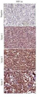 Immunohistochemistry: HIF-1 alpha Antibody (ESEE122) - Azide and BSA Free [NBP2-80762] - Immunohistochemical analysis in non-GIST STS representing negative, and score 1-3 of Carbonic Anhydrase IX/CA9, GLUT-1, HIF-1 alpha, and HIF-2 alpha/EPAS1. non-GIST STS: non-gastrointestinal stromal tumor soft-tissue sarcomas, Carbonic Anhydrase IX/CA9: c