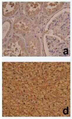 Immunohistochemistry: HIF-1 alpha Antibody (ESEE122) - Azide and BSA Free [NBP2-80762] - Immunohistochemical staining of HIF-1 alpha in normal renal tissue (A) and clear cell renal cell carcinoma (CCRCC) (D). A homogeneous cytoplasmic staining of tubular cells and weak staining in glomerules was observed with HIF-1 alpha (A). In CCRCC, HIF-1