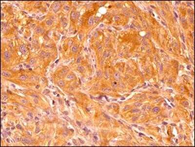 Immunohistochemistry-Paraffin: HIF-1 alpha Antibody (ESEE122) - Azide and BSA Free [NBP2-80762] - Analysis of a FFPE tissue section of human renal cancer xenograft using HIF-1 alpha antibody (NB100-131 Lot 83115) at 1:200 dilution. The antibody generated a strong cytoplasmic staining mainly in the cancer cells. Only a fraction of cells depicted nuclea