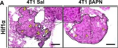 Immunohistochemistry: HIF-1 alpha Antibody (ESEE122) [HRP] [NB100-131H] - Reduced supply is a direct effect of HIF-1 alpha staining in nonvascularized spontaneous lung metastases (outlined) arising in mice implanted with 4T1 tumors. Yellow arrowheads: cells with nuclear HIF-1 alpha immunreactivity. Image collected and cropped by CiteAb from the following publication (//www.nature.com/articles/s41388-018-0320-2), licensed under a CC-BY license.