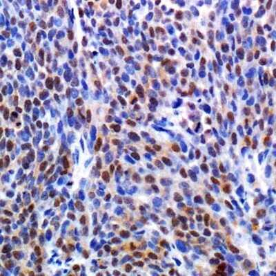 Immunohistochemistry: HIF-1 alpha Antibody (HA111) - Azide and BSA Free [NBP2-80763] - HIF-1 antibody was tested in human ovarian cancer tumor xenograft using DAB with hematoxylin counterstain. Image from the standard format of this antibody.