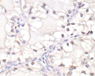 Immunohistochemistry: HIF-1 alpha Antibody Pack [NB100-901IHC] - Detection of human HIF-1 alpha by immunohistochemistry. Sample: FFPE section of renal cell carcinoma. Antibody: Affinity purified rabbit anti-HIF-1 alpha antibody (NB110-58773). Detection: DAB. HIF-1 alpha Antibody [NB100-449]