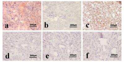 Immunohistochemistry: HIF-1 alpha Antibody Pack [NB100-901IHC] - In situ hybridization (antisense probe, Fig. 3a) and immunostaining with HIF1a Ab2 (Fig. 3c) on thin adjacent sections of NE-differentiated prostate adenocarcinoma showed co-localization of HIF1a1.2 transcript and HIF-1a protein. Incubation with sense probe did not generate any detectable hybridization signals (Fig. 3b). Both In situ hybridization (Fig. 3d antisense) and HIF-1a Ab2 immunostaining (Fig. 3f) were negative in non-NE-differentiated prostate adenocarcinoma. In situ hybridization with sense probe performed on non-NE-differentiated prostate cancer (Fig. 3e). Image collected and cropped by CiteAb from the following publication (//www.biomedcentral.com/1471-2407/10/385), licensed under a CC-BY license. HIF-1 alpha Antibody (H1alpha67) [NB100-123]