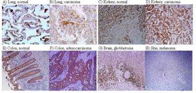 Immunohistochemistry: HIF-1 alpha Antibody Pack [NB100-901IHC] - Immunohistochemical detection of HIF-1alpha protein in human tissues. The nature of the tissue is indicated on top of each figure. Original magnifications are as follows: A, x400; B, x400; C, x100; D, x100; E, x100; F, x100; G, x40; H, x40. Image collected and cropped by CiteAb from the following publication (//bmcgenet.biomedcentral.com/articles/10.1186/1471-2156-5-27), licensed under a CC-BY license. HIF-1 alpha Antibody (H1alpha67) [NB100-123]