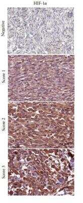Immunohistochemistry: HIF-1 alpha Antibody Pack [NB100-901IHC] - Immunohistochemical analysis in non-GIST STS representing negative, and score 1-3 of Carbonic Anhydrase IX/CA9, GLUT-1, HIF-1 alpha, and HIF-2 alpha/EPAS1. non-GIST STS: non-gastrointestinal stromal tumor soft-tissue sarcomas, Carbonic Anhydrase IX/CA9: carbonic anhydrase IX, GLUT-1: glucose transporter-1, and HIF-1/2alpha: hypoxia induced factor 1/2alpha. Image collected and cropped by CiteAb from the following publication (//www.hindawi.com/journals/sarcoma/2012/541650/), licensed under a CC-BY license. HIF-1 alpha Antibody (ESEE122) [NB100-131]