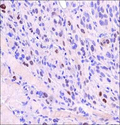 Immunohistochemistry: HIF-2 alpha/EPAS1 Antibody (2444A) - Azide and BSA Free [NBP2-80767] - Analysis of an FFPE tissue section of the human renal carcinoma using 1:100 dilution of HIF-2 alpha antibody (NBP2-76454). The signal was developed using HRP-DAB method which followed counterstaining of the cells with hematoxylin. The antibody generated s