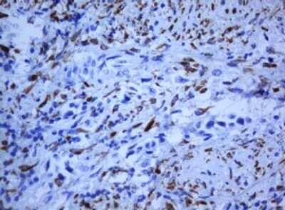 Immunohistochemistry: HIF-3 alpha Antibody (OTI2D2) - Azide and BSA Free [NBP2-72136] - Analysis of Carcinoma of Human bladder tissue. (Heat-induced epitope retrieval by 10mM citric buffer, pH6.0, 120C for 3min)