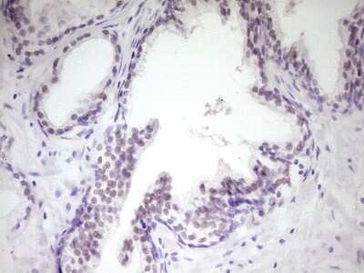 Immunohistochemistry: HIPK1 Antibody (5F1) [NBP2-45973] - Analysis of Carcinoma of Human prostate tissue. (Heat-induced epitope retrieval by 1 mM EDTA in 10mM Tris, pH8.5, 120C for 3min)