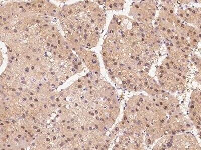 Immunohistochemistry-Paraffin: HIPK2 Antibody [NBP2-99584] - Staining of human HIPK2 in human hepatoma with rabbit polyclonal antibody at 1:200 dilution.