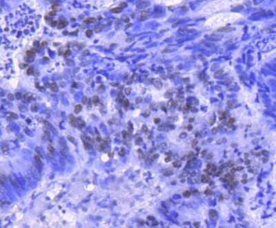 Immunohistochemistry-Paraffin: HIST1H2BK [ac Lys20] Antibody (SN72-09) [NBP2-67682] - Analysis of paraffin-embedded human colon cancer tissue using anti-Histone H2B(acetyl K20) antibody. Counter stained with hematoxylin.