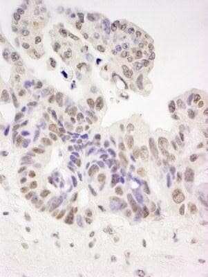 Immunohistochemistry-Paraffin: HIV-1 Tat specific factor 1 Antibody [NBP1-18912] - FFPE of human ovarian carcinoma.  Affinity purified rabbit anti-Tat-SF1 dilution of 1:250.