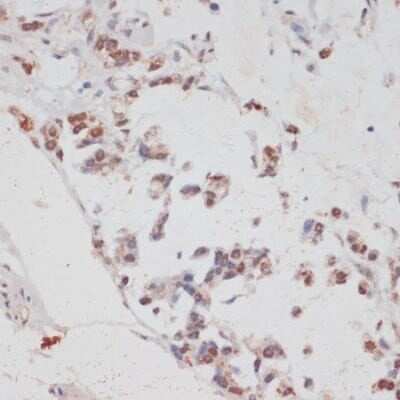 Immunohistochemistry-Paraffin: HIV-1 Tat specific factor 1 Antibody [NBP3-03306] - Paraffin-embedded human gastric cancer using HIV-1 Tat specific factor 1 antibody at dilution of 1:100 (40x lens).