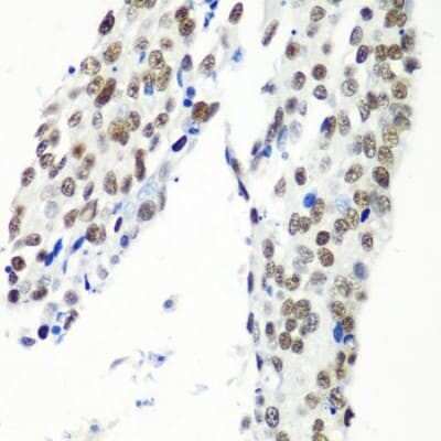 Immunohistochemistry-Paraffin: HIV-1 Tat specific factor 1 Antibody [NBP3-03409] - Paraffin-embedded human lung cancer using HIV-1 Tat specific factor 1 antibody at dilution of 1:100 (40x lens).