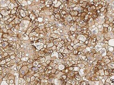 Immunohistochemistry-Paraffin: HLA B7 Antibody [NBP3-06116] - Immunochemical staining of human HLAB7 in human hepatoma with rabbit polyclonal antibody (1:1000, formalin-fixed paraffin embedded sections).