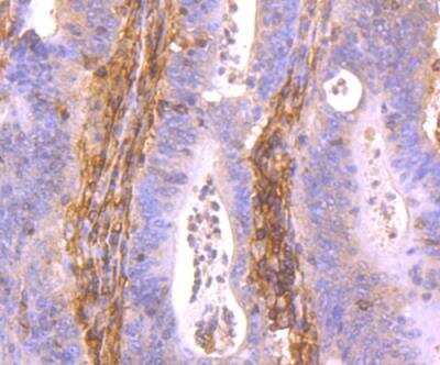 Immunohistochemistry-Paraffin: HLA Class I Antibody [NBP2-75928] - analysis of paraffin-embedded human colon cancer tissue using anti-HLA Class 1 ABC antibody. Counter stained with hematoxylin.
