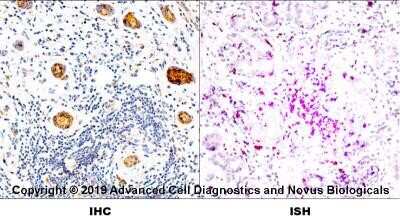 Dual RNAscope ISH-IHC: HLA-DR Antibody (L243) - Azide and BSA Free [NBP2-80773] - Formalin-fixed paraffin-embedded tissue sections of human metastatic tonsil were probed for HLA-DR mRNA (ACD RNAScope probe, catalog # 475891; Fast Red chromogen, ACD catalog # 322500). Adjacent tissue section was processes for immunohistochemistry using mouse monoclonal (Novus catalog # NB100-77855) at 1:50 dilution for 1 hour at room temperature followed by incubation with the anti-mouse IgG VisUCyte HRP Polymer Antibody (Catalog # VC001) and DAB chromogen (yellow-brown). Tissue was counterstained with hematoxylin (blue). Image from the standard format of this antibody.