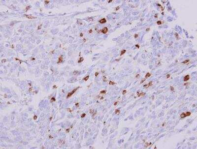 Immunohistochemistry-Paraffin: HLA DRA Antibody [NBP1-31512] - Paraffin-embedded Leukocytes in liver carcinoma. HLA-DRA antibody dilution: 1:250.