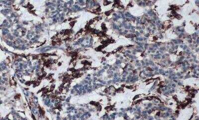 Immunohistochemistry-Paraffin: HLA DRA Antibody [NBP1-33458] - Human breast carcinoma. HLA-DRA stained by HLA-DRA antibody [N2C3] diluted at 1:10000. Antigen Retrieval: Citrate buffer, pH 6.0, 15 min. 