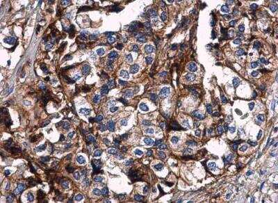 Immunohistochemistry-Paraffin: HLA G Antibody [NBP2-16855] - Human lung cancer. HLA-G antibody diluted at 1:500. Antigen Retrieval: Citrate buffer, pH 6.0, 15 min