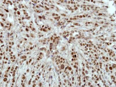 Immunohistochemistry-Paraffin: HLTF Antibody [NBP2-16857] - Immunohistochemical analysis of paraffin-embedded MB157 xenograft, using antibody at 1:500 dilution.