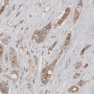 Immunohistochemistry-Paraffin: HMG-CoA Reductase/HMGCR Antibody (CL0259) [NBP2-61616] - Staining of human breast cancer shows moderate cytoplasmic immunoreactivity in tumor cells.