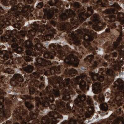 Immunohistochemistry-Paraffin: HMG-CoA Reductase/HMGCR Antibody (CL0259) [NBP2-61616] - Staining of human liver cancer shows strong cytoplasmic positivity in tumor cells.