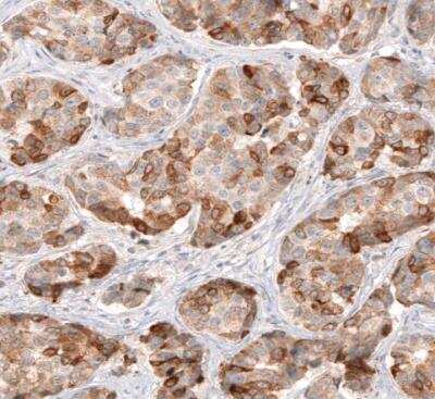 Immunohistochemistry-Paraffin: HMG-CoA Reductase/HMGCR Antibody (CL0260) [NBP2-61617] - Staining of human breast cancer shows moderate to strong cytoplasmic positivity in tumor cells.