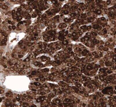 Immunohistochemistry-Paraffin: HMG-CoA Reductase/HMGCR Antibody (CL0260) [NBP2-61617] - Staining of human liver cancer shows strong cytoplasmic positivity in tumor cells.