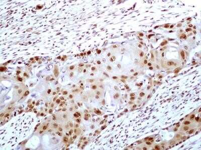 Immunocytochemistry: HMGB1/HMG-1 Antibody (19N15F4) - Azide and BSA Free [NBP2-80775] - Analysis of HMGB1 protein in a tissue section of human esophageal squamous cell carcinoma (SCC) using HMGB1 antibody (clone 19N15F4) at a concentration of 5 ug/ml. Strong nuclear along with weak cytoplasmic immunopositivity for HMGB1 was observed in SCC c