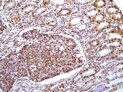 Immunohistochemistry: HMGB1/HMG-1 Antibody (19N15F4) - Azide and BSA Free [NBP2-80775] - Analysis of HMGB1 protein in a section of human small intestinal cancer tissue using HMGB1 antibody (clone 19N15F4) at a concentration of 5 ug/ml. Intense nuclear immunopositivity of HMGB1 was observed in cancer cells and the cells of tumor stroma as well