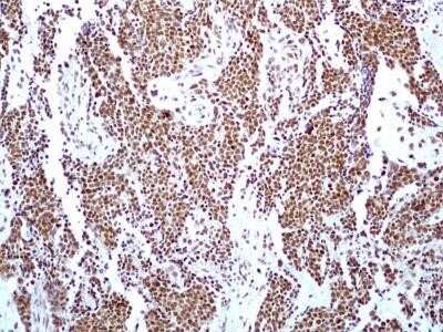 Immunohistochemistry: HMGB1/HMG-1 Antibody (19N15F4) - Azide and BSA Free [NBP2-80775] - Analysis of HMGB1 protein in a tissue section of human bladder transitional cell carcinoma (TCC) / urothelial cell carcinoma (UCC) using HMGB1 antibody (clone 19N15F4) at a concentration of 5 ug/ml. Almost all the cancer cells and the cells of tumor strom