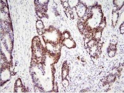 Immunohistochemistry-Paraffin: HMGB1/HMG-1 Antibody (J2E1) [NBP1-07087] - Paraffin embedded sections of human colon cancer tissue were incubated with anti-human HMGB1 (1:200) for 2 hours at room temperature. Antigen retrieval was performed in 0.1M sodium citrate buffer and detected using Diaminobenzidine (DAB).