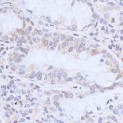 Immunohistochemistry-Paraffin: HMGN3/TRIP7 Antibody [NB100-59839] - Detection of human HMGN3 by immunohistochemistry. Sample: FFPE section of human lung carcinoma. Antibody: Affinity purified rabbit anti-HMGN3 (NB100-59839). Detection: DAB