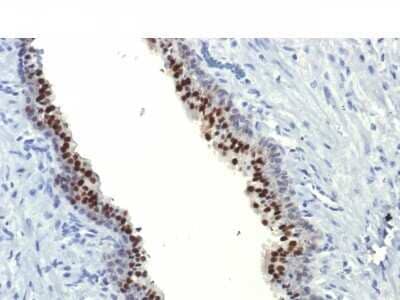 Immunohistochemistry-Paraffin: HNF-3 alpha/FoxA1 Antibody (FOXA1/1514) [NBP2-54575] - Formalin-fixed, paraffin-embedded human Prostate Carcinoma stained with FOXA1 Monoclonal Antibody (FOXA1/1514).