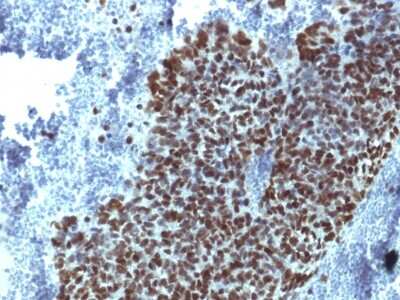 Immunohistochemistry-Paraffin: HNF-3 alpha/FoxA1 Antibody (FOXA1/1514) [NBP2-54575] - Formalin-fixed, paraffin-embedded human Prostate Carcinoma stained with FOXA1 Monoclonal Antibody (FOXA1/1514).