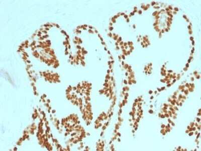 Immunohistochemistry-Paraffin: HNF-3 alpha/FoxA1 Antibody (FOXA1/1515) - Azide and BSA Free [NBP2-54415] - Formalin-fixed, paraffin-embedded human Prostate Carcinoma stained with FOXA1 Monoclonal Antibody (FOXA1/1515).