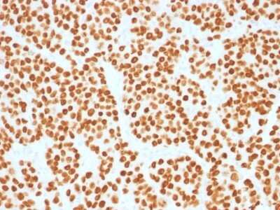 Immunohistochemistry-Paraffin: HNF-3 alpha/FoxA1 Antibody (FOXA1/1515) - Azide and BSA Free [NBP2-54415] - Formalin-fixed, paraffin-embedded human Prostate Carcinoma stained with FOXA1 Monoclonal Antibody (FOXA1/1515).