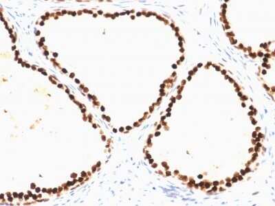 Immunohistochemistry-Paraffin: HNF-3 alpha/FoxA1 Antibody (FOXA1/1515) - Azide and BSA Free [NBP2-54415] - Formalin-fixed, paraffin-embedded human Prostate Carcinoma stained with HNF-3 alpha/FoxA1 Antibody (FOXA1/1515).