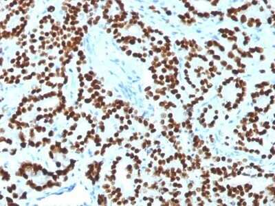 Immunohistochemistry-Paraffin: HNF-3 alpha/FoxA1 Antibody (FOXA1/1518) - Azide and BSA Free [NBP2-54414] - Formalin-fixed, paraffin-embedded human Prostate Carcinoma stained with FOXA1 Monoclonal Antibody (FOXA1/1518).