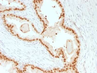 Immunohistochemistry-Paraffin: HNF-3 alpha/FoxA1 Antibody (rFOXA1/1515) - Azide and BSA Free [NBP3-08920] - Formalin-fixed, paraffin-embedded human Prostate Carcinoma stained with HNF-3 alpha/FoxA1 Mouse Recombinant Monoclonal Antibody (rHNF-3 alpha/FoxA1/1515).